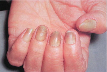 Pterygium Nail Disease