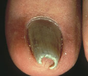 Pterygium Nail Disease