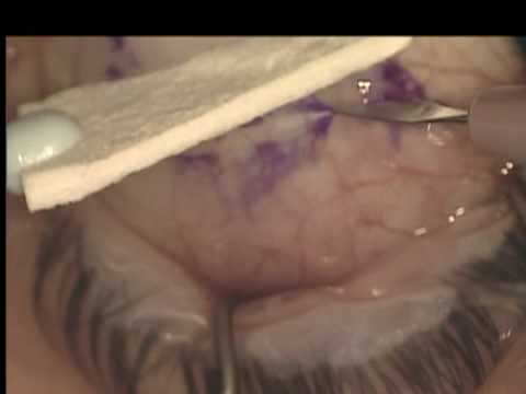 Pterygium Removal