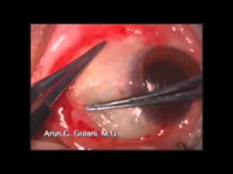 Pterygium Removal Cost