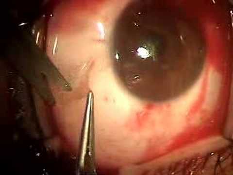 Pterygium Removal Cost