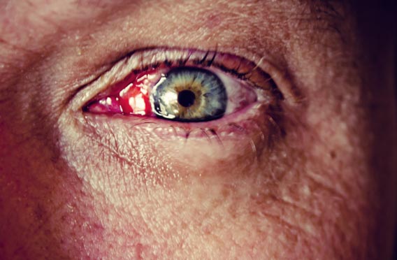 Pterygium Surgery Risks