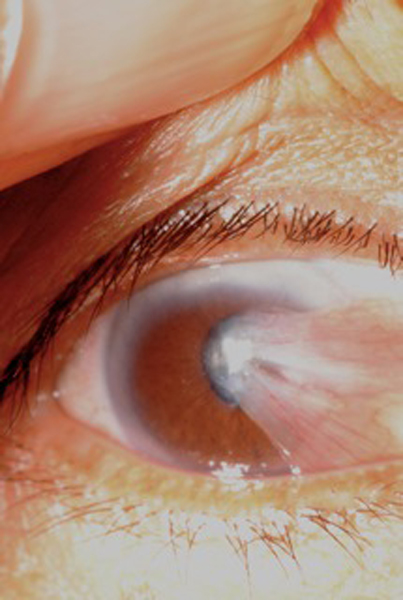 Pterygium Surgery San Francisco