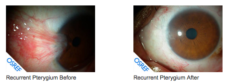 Pterygium Surgery San Francisco