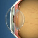 Pterygium Surgery San Francisco