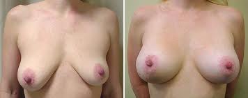 Ptosis Breast Implants