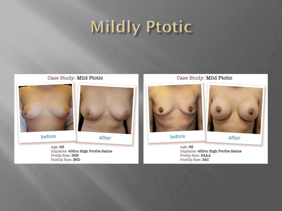 Ptosis Breast Implants