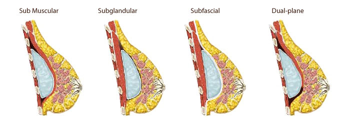 Ptosis Breast Implants