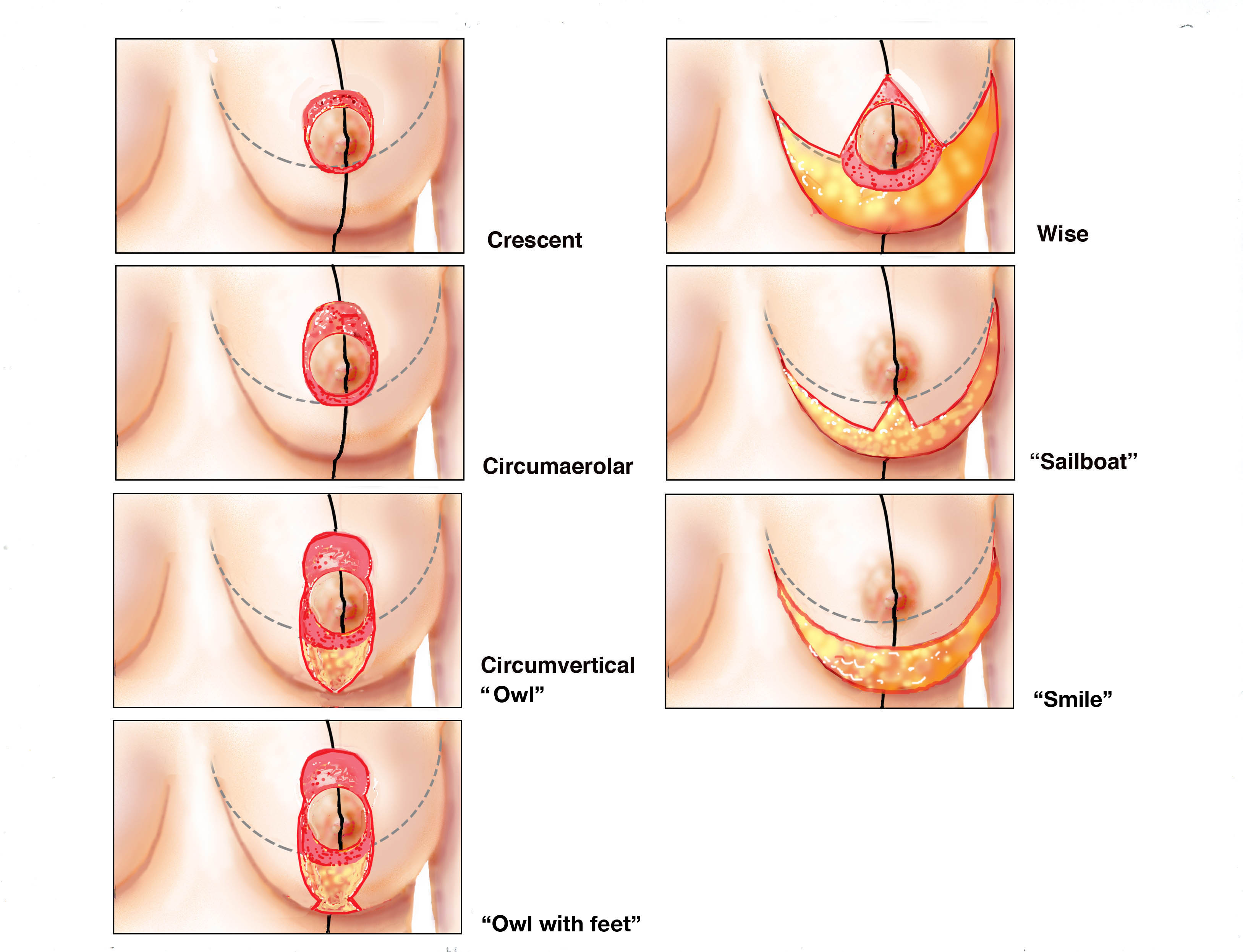 Ptosis Breast Pictures