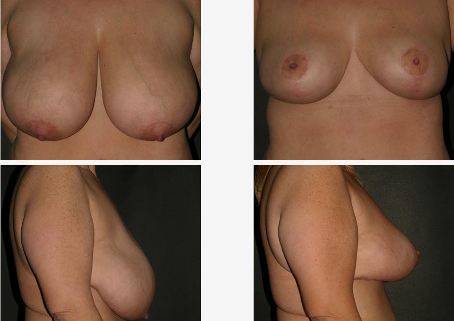 Ptosis Breast Pictures