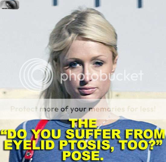 Ptosis Eye