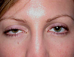 Ptosis Eye Surgery