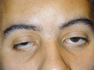 Ptosis Palpebral