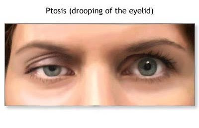 Ptosis Palpebral