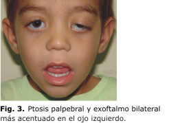 Ptosis Palpebral