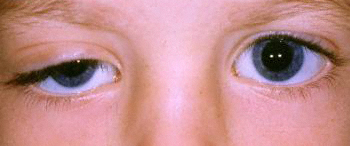 Ptosis Palpebral