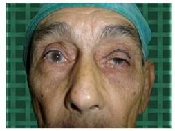 Ptosis Palpebral