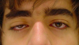 Ptosis Palpebral Unilateral Causas