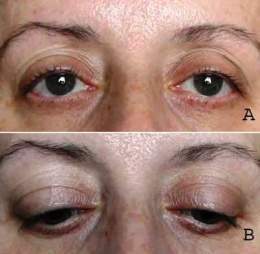 Ptosis Palpebral Unilateral Causas