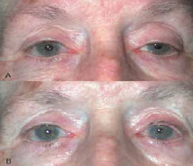 Ptosis Palpebral Unilateral Causas