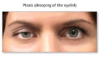 Ptosis Palpebral Unilateral Causas