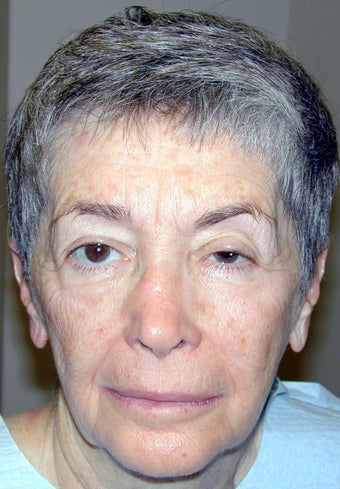 Ptosis Repair