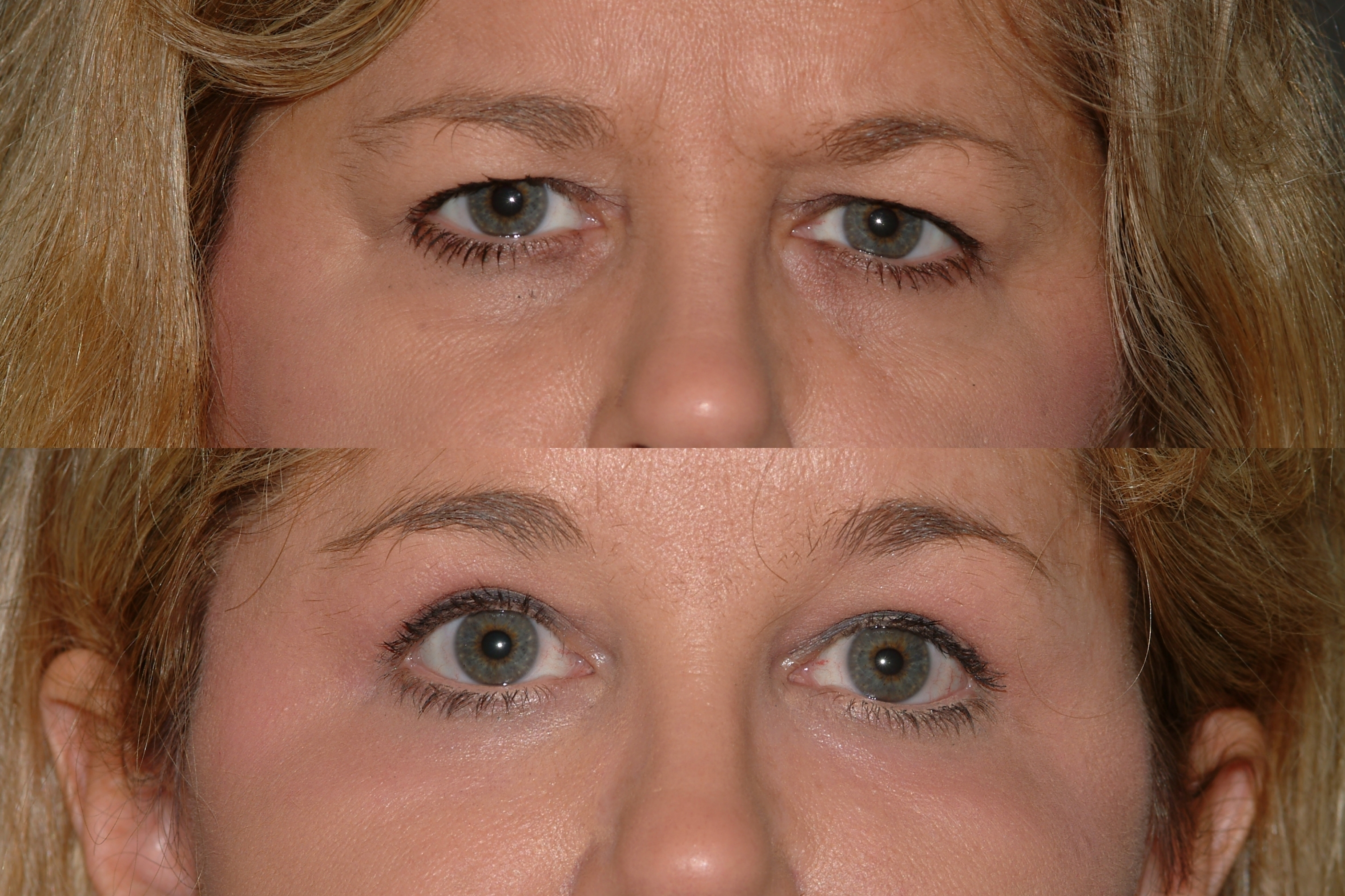 Ptosis Repair Procedure