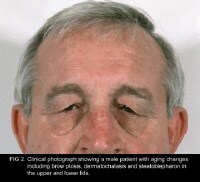 Ptosis Repair Procedure