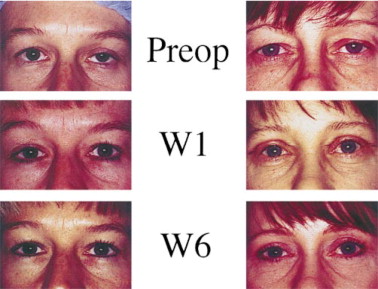 Ptosis Surgery