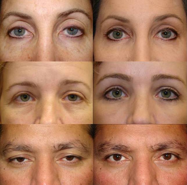 Ptosis Surgery Photos