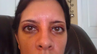 Ptosis Surgery Photos