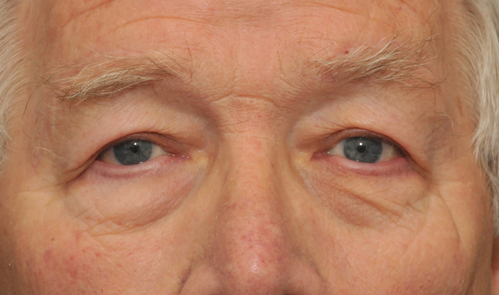 Ptosis Treatment Botox