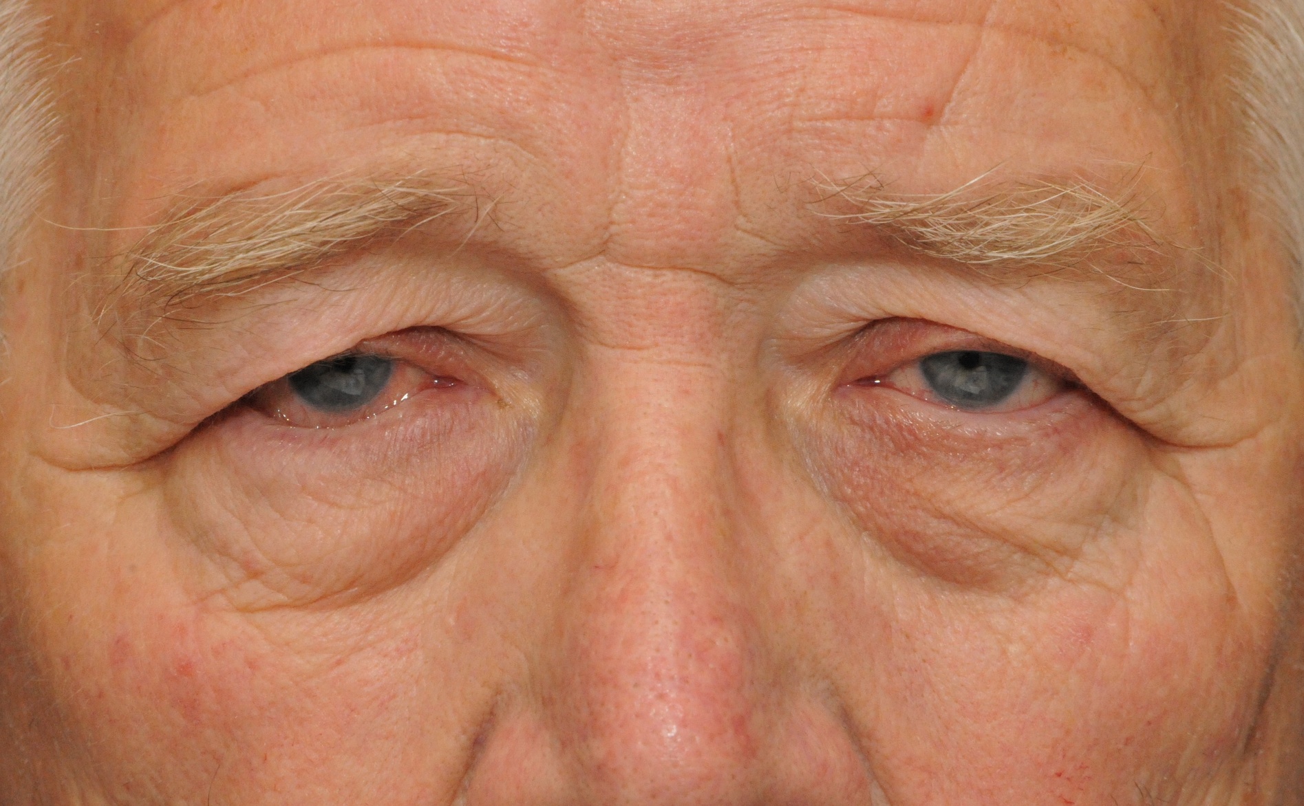 Ptosis Treatment Botox