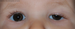 Ptosis Treatment In Children