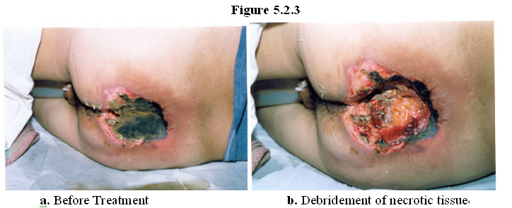 Sacral Pressure Ulcer Pictures