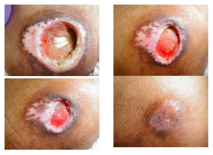 Sacral Pressure Ulcer Pictures