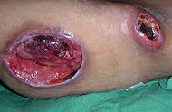 Stage 4 Pressure Ulcer Pictures