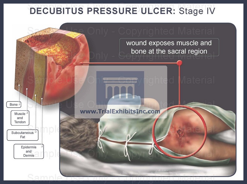 Stage Iv Pressure Ulcer Pictures