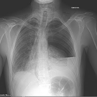 Subjective And Objective Data For Ineffective Airway Clearance