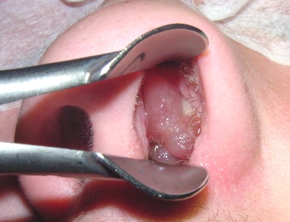 Subjective And Objective Data For Ineffective Airway Clearance