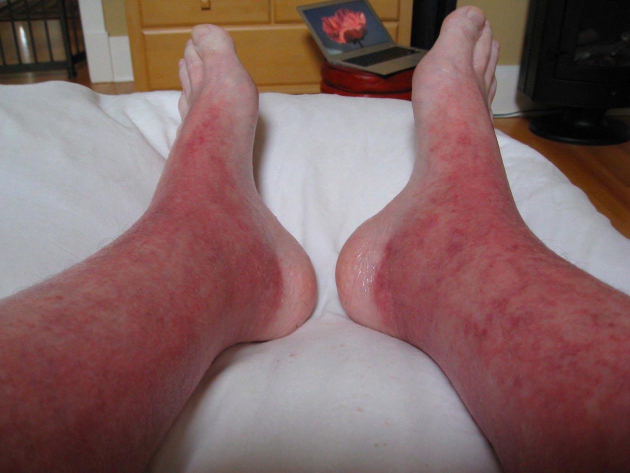 Topical Steroid Withdrawal Treatment