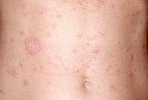 Types Of Skin Rashes In Adults