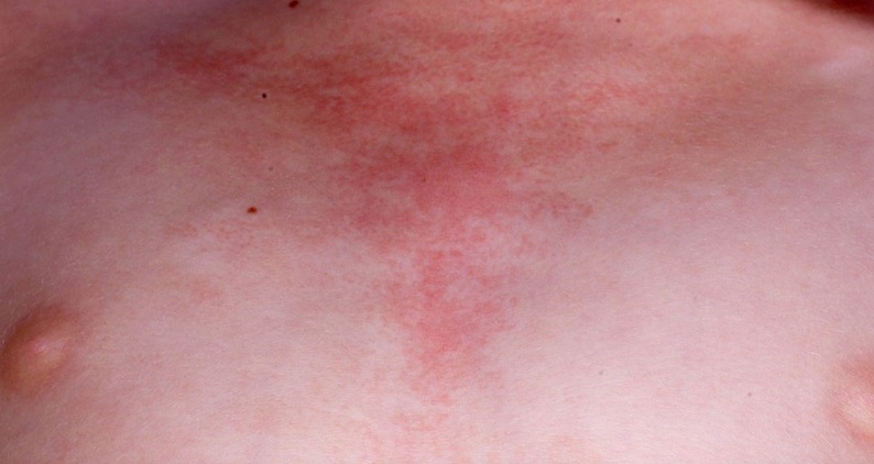 Types Of Skin Rashes In Adults