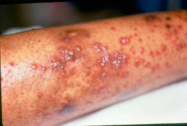 Types Of Skin Rashes In Adults