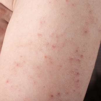 Types Of Skin Rashes In Adults