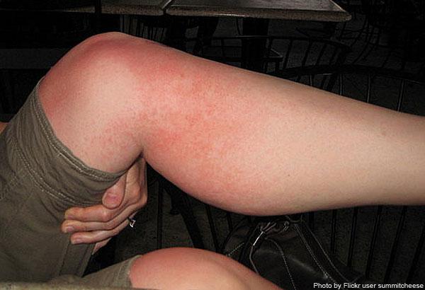 Types Of Skin Rashes In Adults