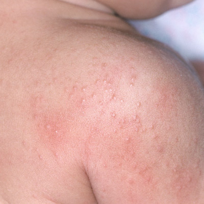 Types Of Skin Rashes On Back