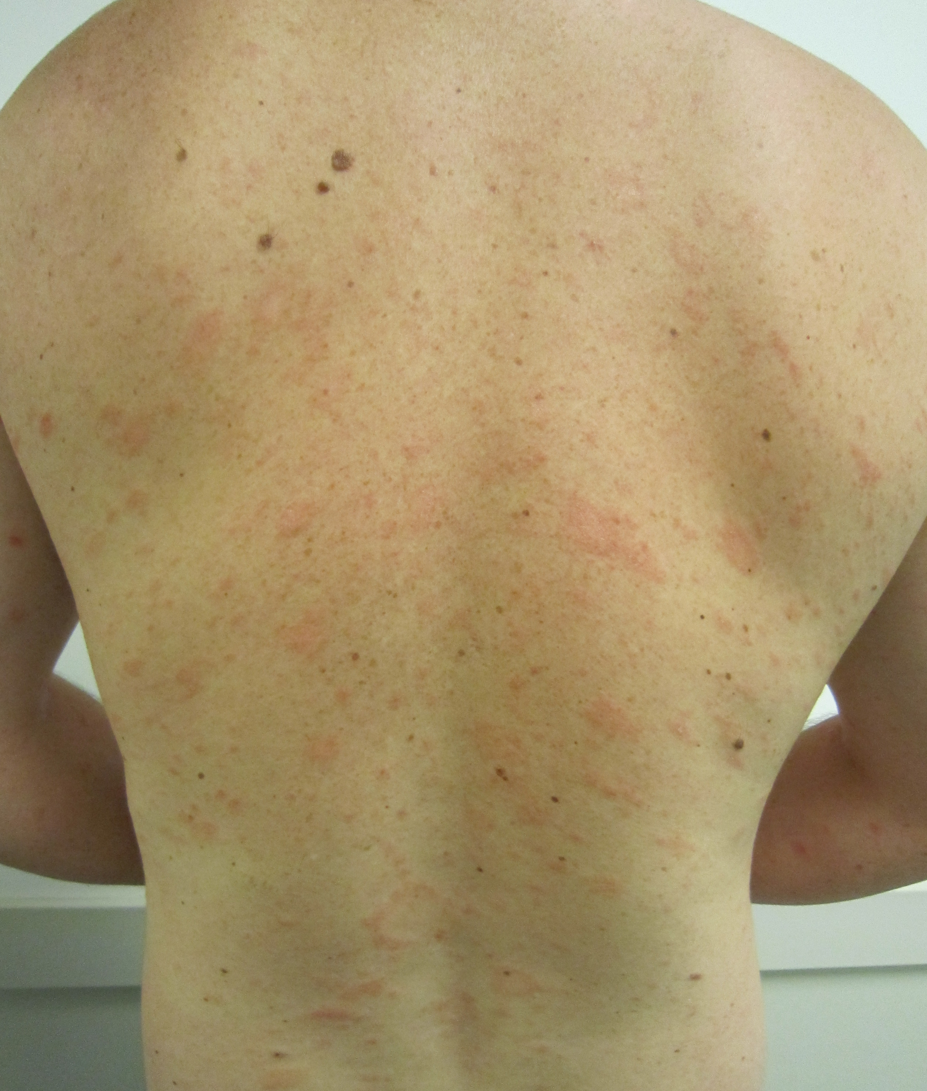 Types Of Skin Rashes On Back