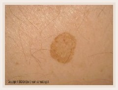 Types Of Skin Rashes On Back