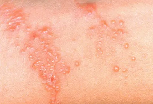 Types Of Skin Rashes On Back